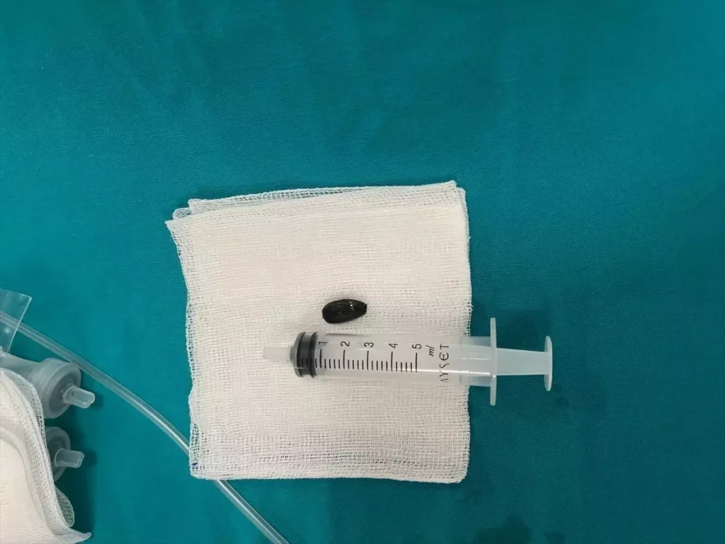 Batman’da 15 Aylık Bebek Ameliyatla Sağlığına Kavuştu