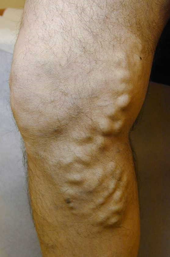 Varis Nedir? Varis Neden Oluşur, Belirtileri Nelerdir?